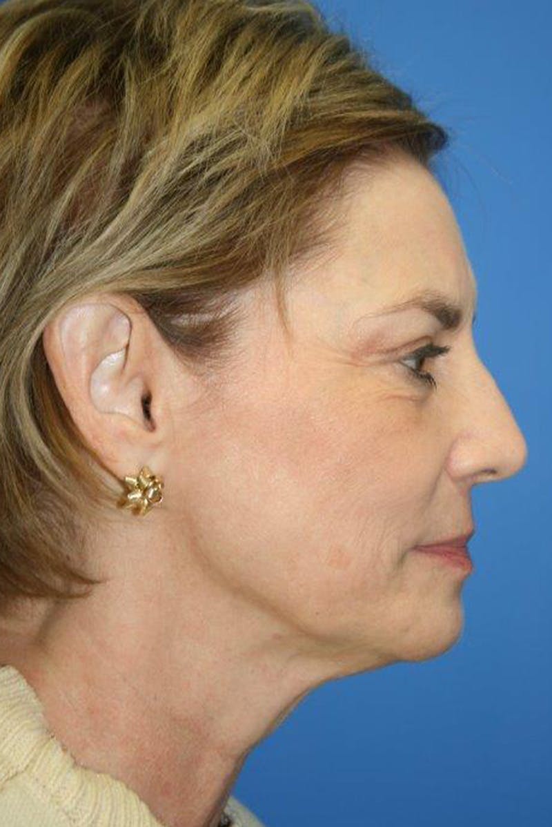 Neck Lift Before & After Gallery - Patient 260851 - Image 3