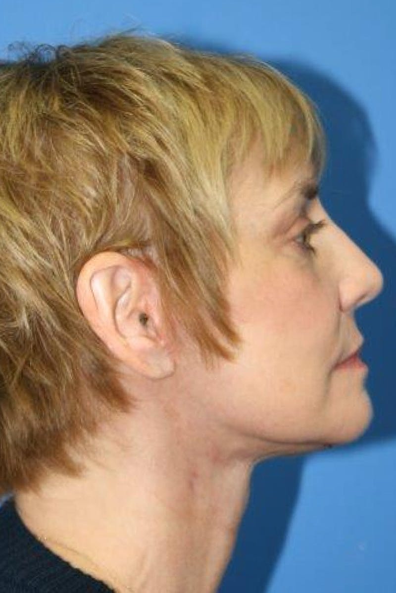 Neck Lift Before & After Gallery - Patient 260851 - Image 4