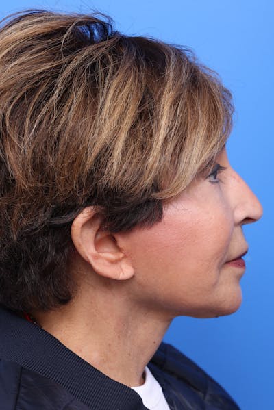 Deep Plane Facelift Before & After Gallery - Patient 104338 - Image 2