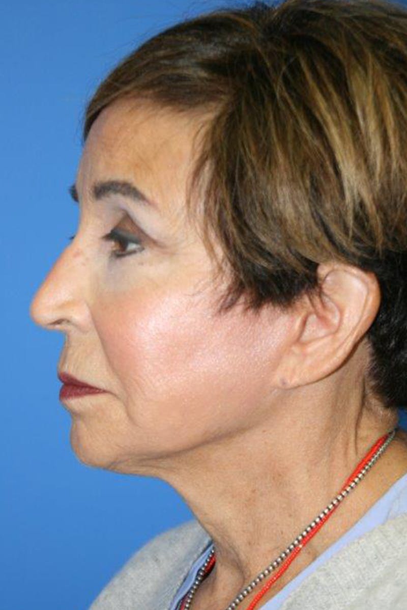 Neck Lift Before & After Gallery - Patient 555360 - Image 3