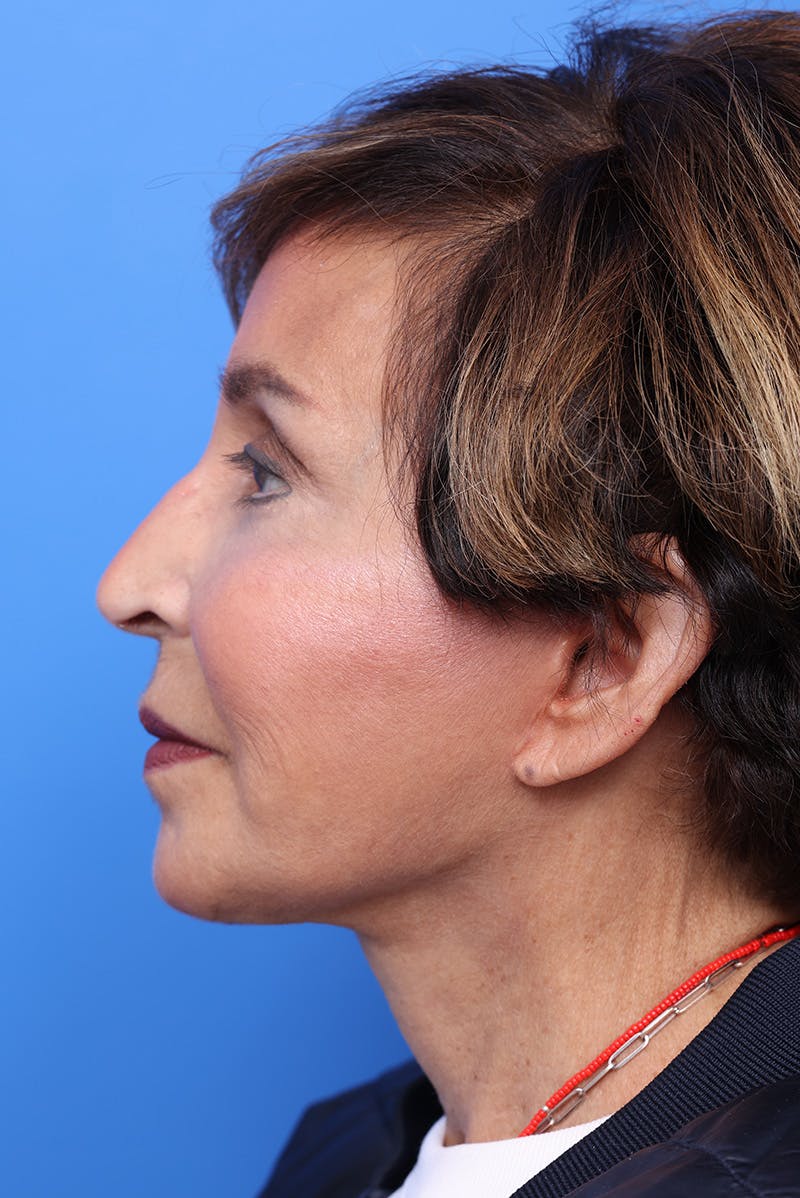 Neck Lift Before & After Gallery - Patient 555360 - Image 4