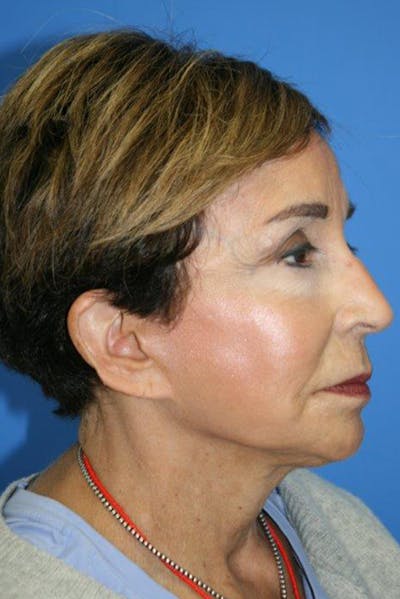 Deep Plane Facelift Before & After Gallery - Patient 104338 - Image 1