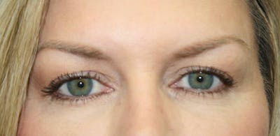 Upper Eyelid Lift Before & After Gallery - Patient 163811 - Image 1
