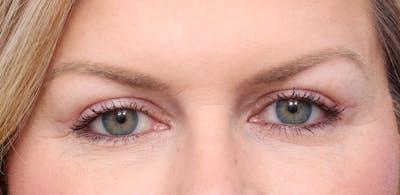 Upper Eyelid Lift Before & After Gallery - Patient 163811 - Image 2