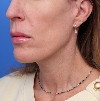 Deep Plane Facelift Before & After Gallery - Patient 535240 - Image 2