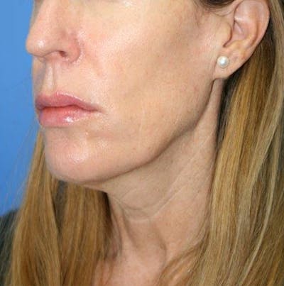 Deep Plane Facelift Before & After Gallery - Patient 535240 - Image 1