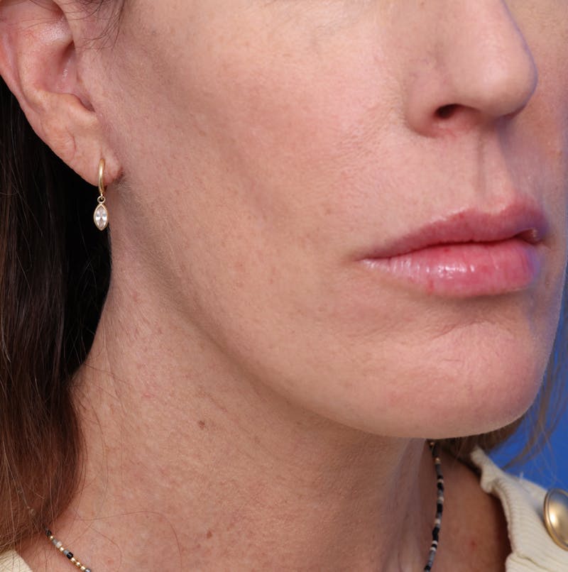 Neck Lift Before & After Gallery - Patient 242103 - Image 8