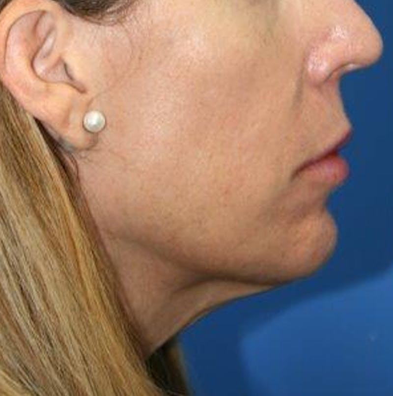 Neck Lift Before & After Gallery - Patient 242103 - Image 5