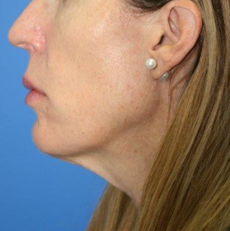 Neck Lift Before & After Gallery - Patient 242103 - Image 3