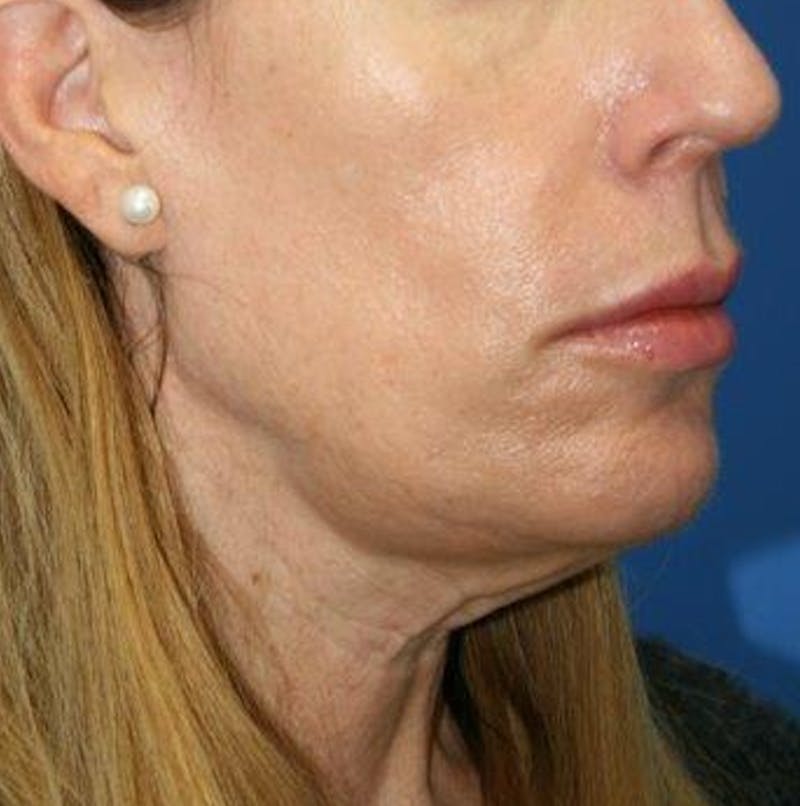 Neck Lift Before & After Gallery - Patient 242103 - Image 7