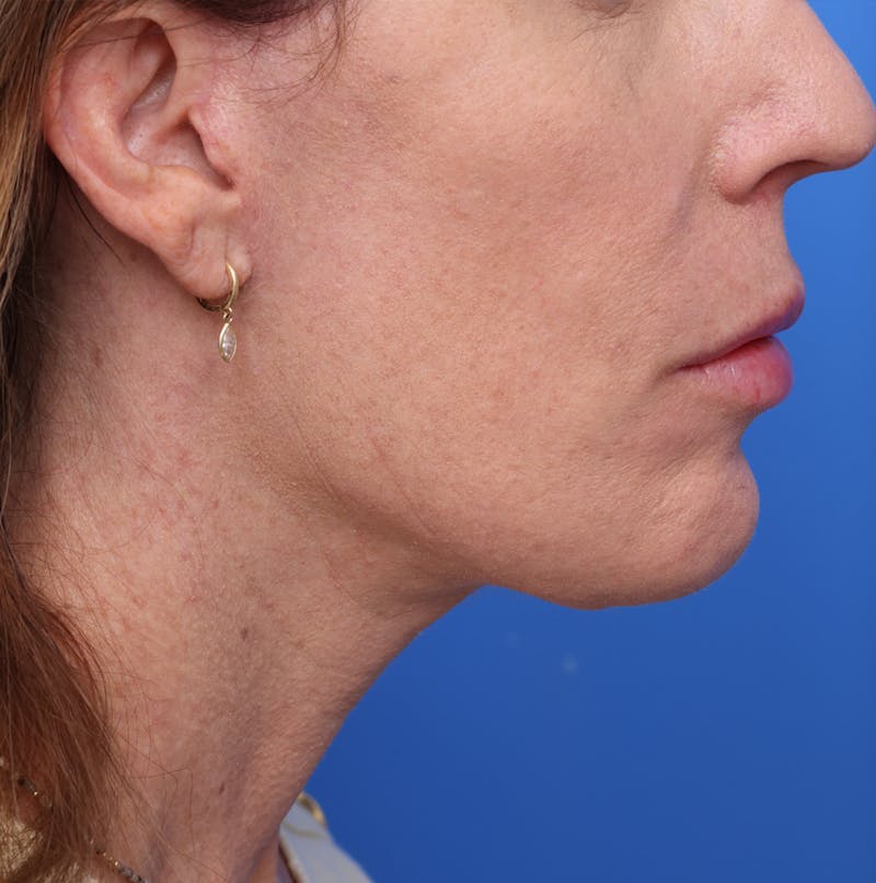 Neck Lift Before & After Gallery - Patient 242103 - Image 6