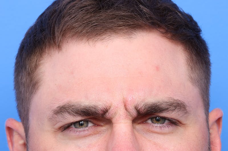 Injectables (Botox, Filler, etc.) Before & After Gallery - Patient 359937 - Image 1