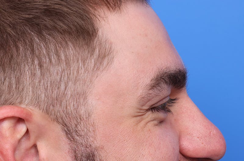 Injectables (Botox, Filler, etc.) Before & After Gallery - Patient 359937 - Image 5