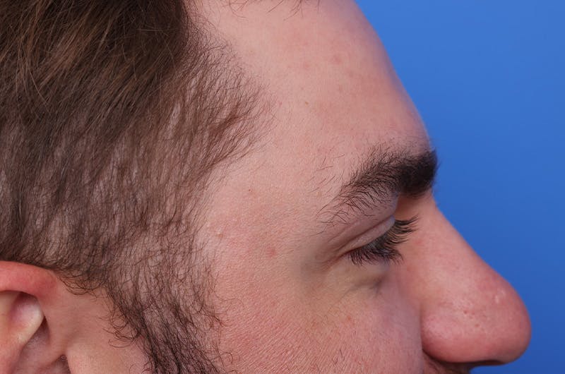 Injectables (Botox, Filler, etc.) Before & After Gallery - Patient 359937 - Image 6