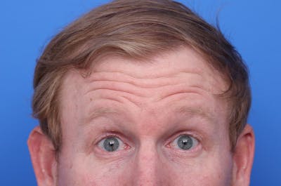 Injectables (Botox, Filler, etc.) Before & After Gallery - Patient 411434 - Image 1