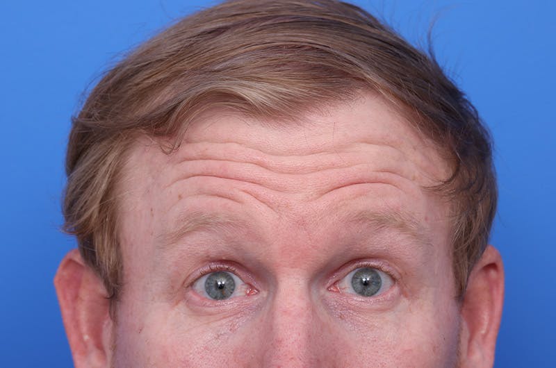 Injectables (Botox, Filler, etc.) Before & After Gallery - Patient 411434 - Image 1