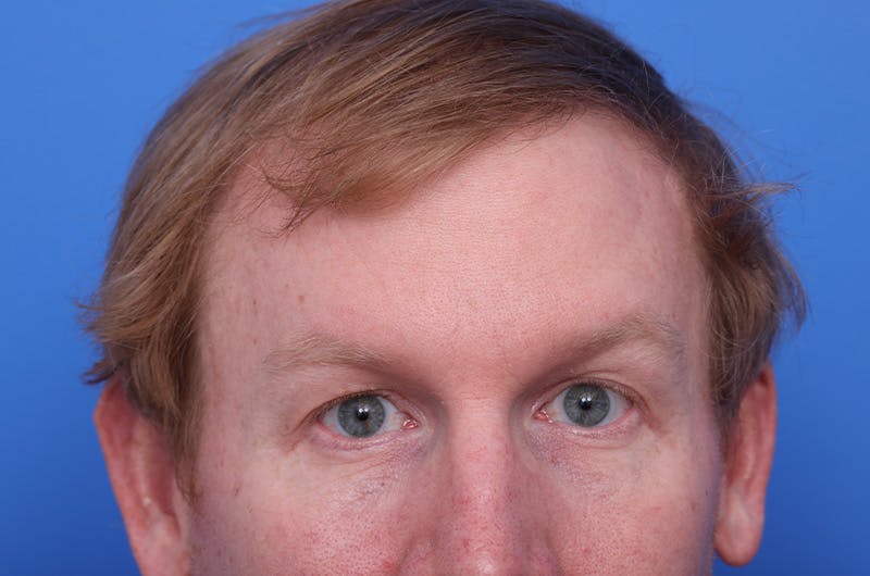 Injectables (Botox, Filler, etc.) Before & After Gallery - Patient 411434 - Image 2