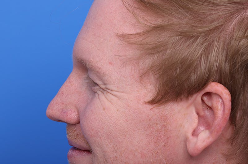 Injectables (Botox, Filler, etc.) Before & After Gallery - Patient 411434 - Image 5