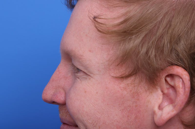 Injectables (Botox, Filler, etc.) Before & After Gallery - Patient 411434 - Image 6