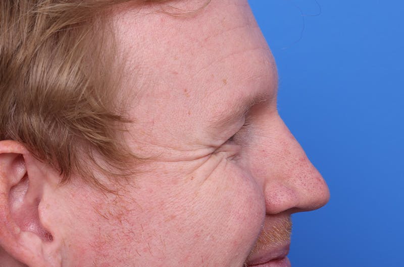 Injectables (Botox, Filler, etc.) Before & After Gallery - Patient 411434 - Image 3