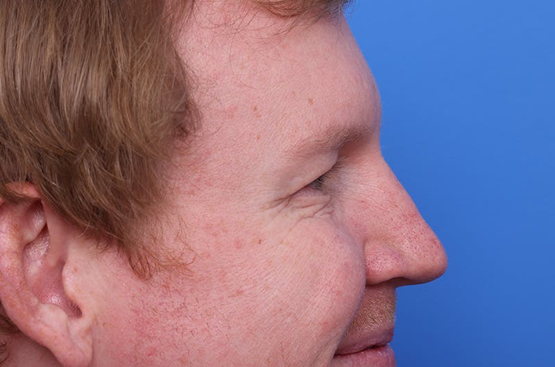 Injectables (Botox, Filler, etc.) Before & After Gallery - Patient 411434 - Image 4
