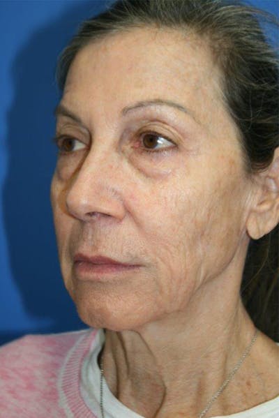 Laser Skin Resurfacing Before & After Gallery - Patient 144354 - Image 1