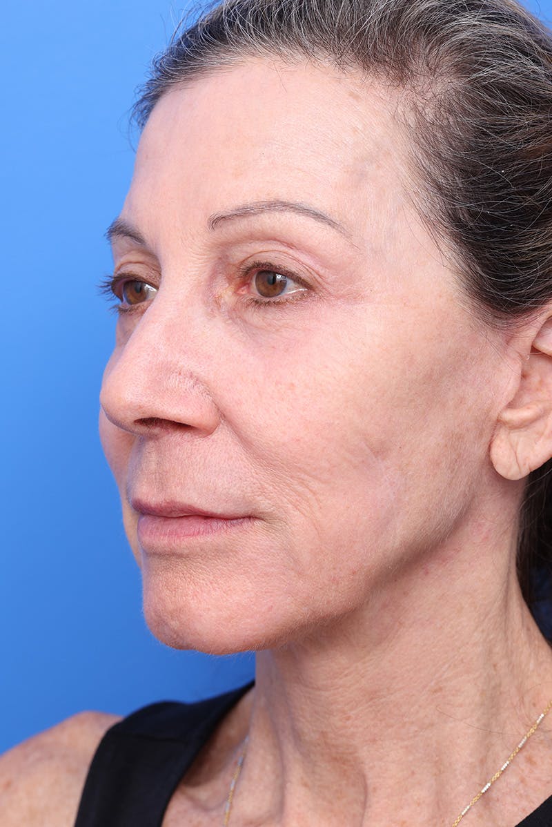 Laser Skin Resurfacing Before & After Gallery - Patient 144354 - Image 2