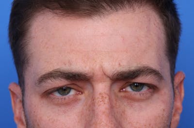 Injectables (Botox, Filler, etc.) Before & After Gallery - Patient 176295 - Image 1