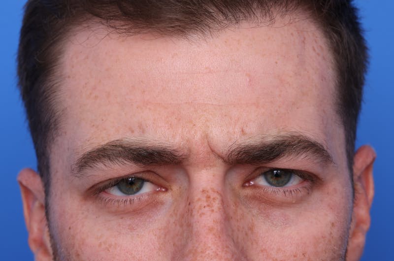 Injectables (Botox, Filler, etc.) Before & After Gallery - Patient 176295 - Image 1