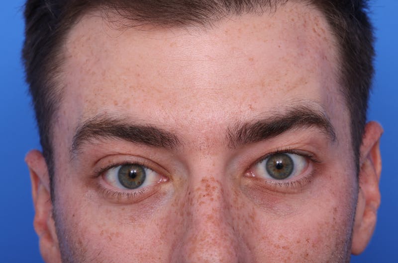 Injectables (Botox, Filler, etc.) Before & After Gallery - Patient 176295 - Image 6