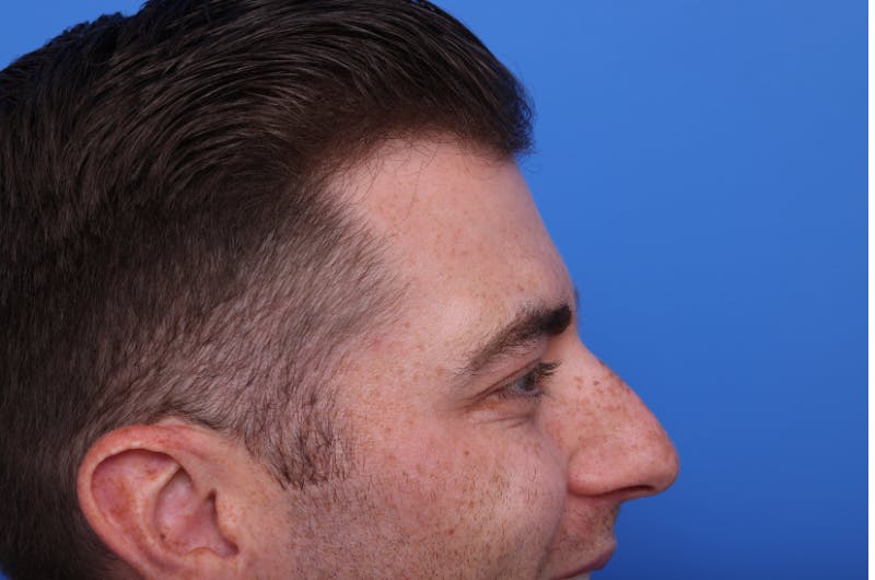 Injectables (Botox, Filler, etc.) Before & After Gallery - Patient 176295 - Image 8