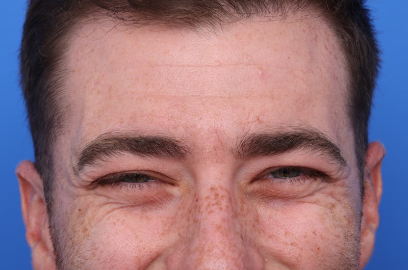 Injectables (Botox, Filler, etc.) Before & After Gallery - Patient 176295 - Image 3