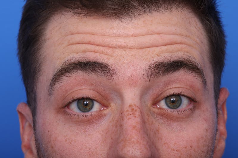 Injectables (Botox, Filler, etc.) Before & After Gallery - Patient 176295 - Image 5