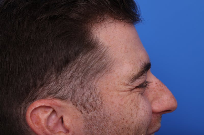 Injectables (Botox, Filler, etc.) Before & After Gallery - Patient 176295 - Image 7