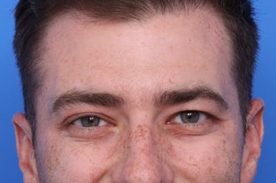 Injectables (Botox, Filler, etc.) Before & After Gallery - Patient 176295 - Image 2