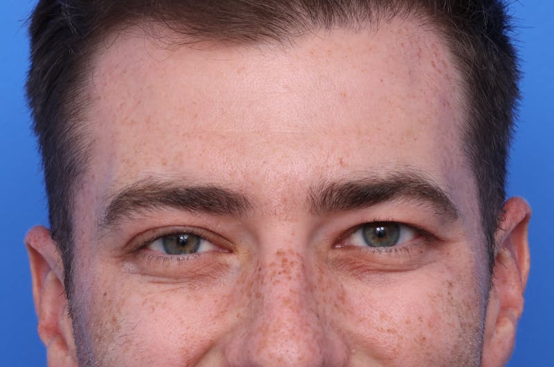 Injectables (Botox, Filler, etc.) Before & After Gallery - Patient 176295 - Image 2