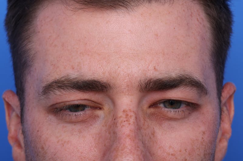 Injectables (Botox, Filler, etc.) Before & After Gallery - Patient 176295 - Image 4