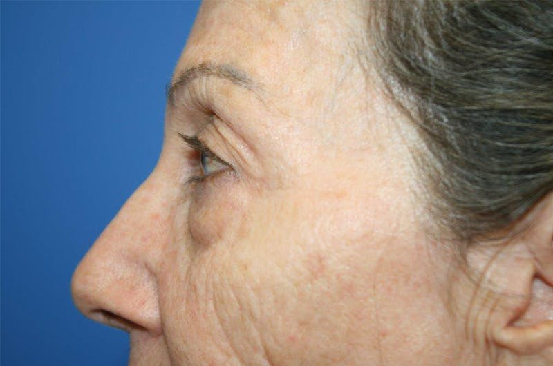 Lower Eyelid Lift Before & After Gallery - Patient 660122 - Image 3