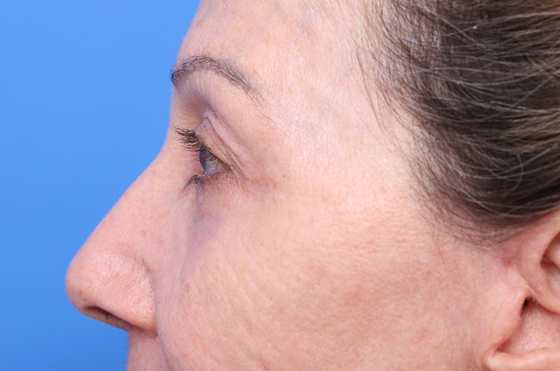 Lower Eyelid Lift Before & After Gallery - Patient 660122 - Image 4