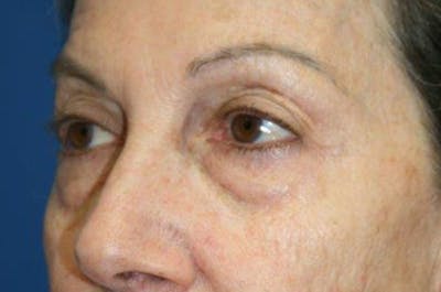 Lower Eyelid Lift Before & After Gallery - Patient 660122 - Image 1
