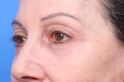 Lower Eyelid Lift Before & After Gallery - Patient 660122 - Image 2