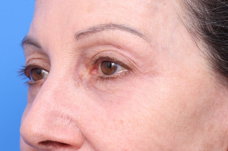 Lower Eyelid Lift Before & After Gallery - Patient 660122 - Image 2