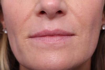 Injectables (Botox, Filler, etc.) Before & After Gallery - Patient 696496 - Image 1