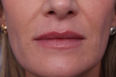 Injectables (Botox, Filler, etc.) Before & After Gallery - Patient 696496 - Image 2
