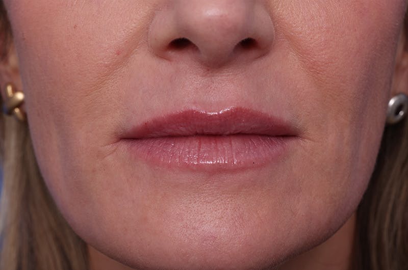 Injectables (Botox, Filler, etc.) Before & After Gallery - Patient 696496 - Image 2