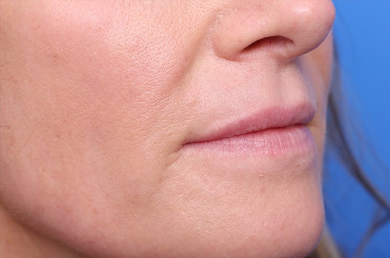 Injectables (Botox, Filler, etc.) Before & After Gallery - Patient 696496 - Image 3