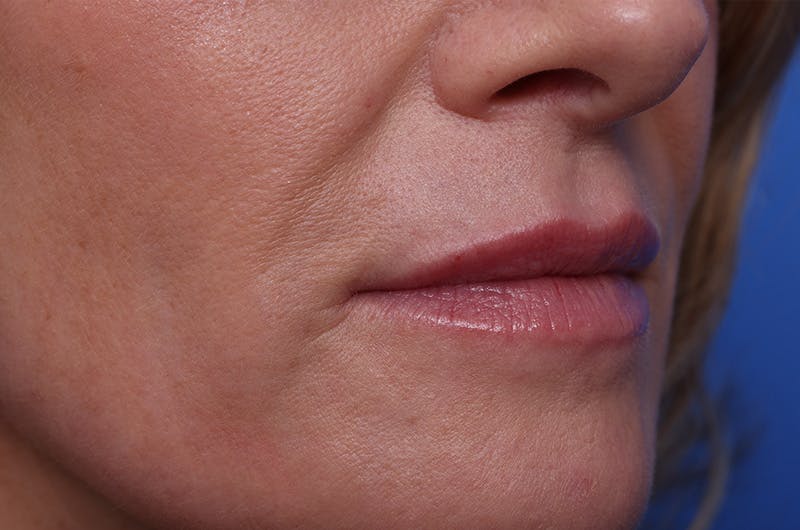 Injectables (Botox, Filler, etc.) Before & After Gallery - Patient 696496 - Image 4