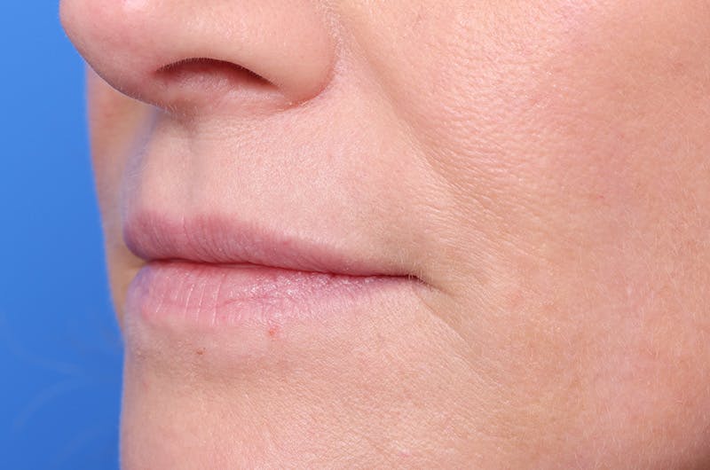Injectables (Botox, Filler, etc.) Before & After Gallery - Patient 696496 - Image 5