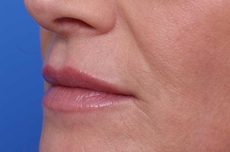 Injectables (Botox, Filler, etc.) Before & After Gallery - Patient 696496 - Image 6