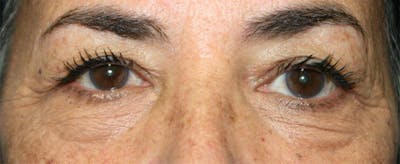 Lower Eyelid Lift Before & After Gallery - Patient 138125 - Image 1